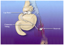 Laparoscopic Banding Surgery offers info on Laparoscopic India, Laparoscopic Banding India, Risks Of Laparoscopic Banding Surgery India