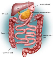 Laparoscopic Biliopancreatic Diversion Surgery offers info on Laparoscopic Surgery India, Biliopancreatic Diversion India