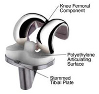 Orthopedic Surgery Abroad Procedures, Orthopedic Surgical Procedures, Orthopedic Surgery