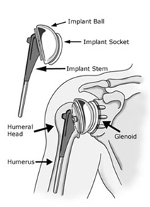 Shoulder Replacement Surgery, Shoulder Replacement Surgery India, Shoulder Replacement Surgery Abroad