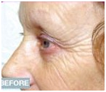 Face Lift Treatment India, Face Lifts India