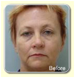 Non Surgical Face Lift India, Non Surgical Face Lift Treatment India, Facial Toning India, Face Exerciser India