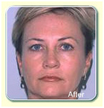 Face Lifts India, Non Surgical Face Lift India, Non Surgical Face Lift Treatment India, Facial Toning India, India Hospital Tour India