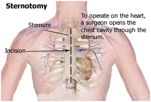 Heart Transplant Surgery India offers info on Cost Heart Transplant India, India Surgery Heart Transplant India, Best India Surgery Price-Heart Transplant India