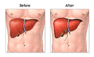 Liver Surgery India, Liver Transplant India, Liver Transplant Delhi India, Liver Transplant Chennai India, Cirrhosis India