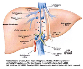 Liver Surgery India, Liver Transplant Delhi India, Cirrhosis India