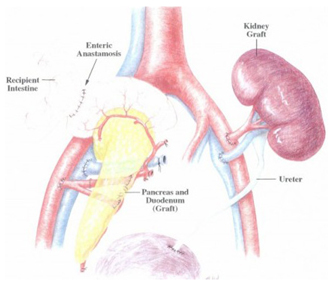 Organ Transplant  India, Pancreas Transplant In  India, Kidney Pancreas Transplant India