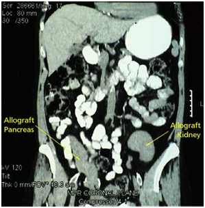 Organ Transplant  India, Kidney Pancreas Transplant India