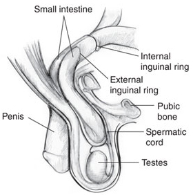 Inguinal Hernia India Surgery offers info on Cost Inguinal Hernia Repair Hospital India, Inguinal Hernia India, Inguinal Hernia Cause India