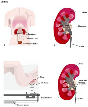 Lithotripsy India Surgery offers info on Lithotripsy India, Cost Lithotripsy Hospital India, Kidney Stone India, Hernia Repair India