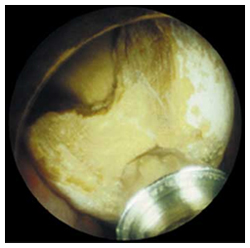 Percutaneous Nephrolithotomy Surgery India, Cost Percutaneous Nephrolithotomy Surgery India, Percutaneous Nephrolithotomy Mumbai-Delhi India