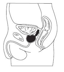 Radical Prostatectomy India, Low Cost Radical Prostatectomy Delhi India, Radical Prostatectomy Surgery Hospital Delhi India