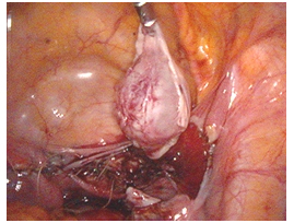 Total Cystectomy Surgery India offers info on Cost Total Cystectomy Surgery India, Low Cost Total Cystectomy Mumbai India