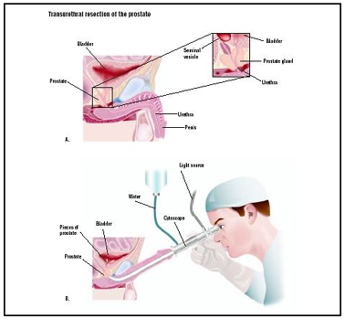 Cost TURP-Transurethral Resection of Prostate Surgery India, TURP-Transurethral Resection of the Prostate surgery India