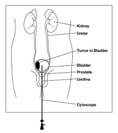 TURBT-Transurethral Resection of the Bladder Tumor surgery India offers info on Cost TURBT-Transurethral Resection of the Bladder Tumor Surgery India