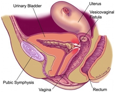 Vesicovaginal Fistula India Surgery offers info on Cost Vesicovaginal Fistula India, Vesicovaginal Fistula India