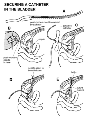 Vesicovaginal Fistula India, Cost Vesicovaginal Fistula India, Vesicovaginal Fistula Mumbai India, Delhi India