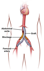 Arterial Bypass Surgery India offers info on Cost Coronary Artery Bypass Surgery India, Coronary Artery Bypass Surgery India