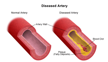 Carotid Artery Stenosis Treatment India offers info on Cost Carotid Artery-Stenosis Surgery India, Cost Carotid Artery-Stenosis Hospital India