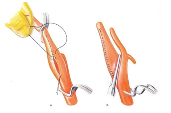 Carotid Artery Stenosis Treatment India offers info on Cost Carotid Artery-Stenosis Surgery India, Carotid Artery Disease Treatment India