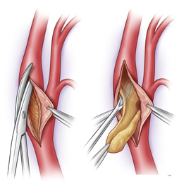 Carotid Endarterectomy Surgery India offers info on Cost Carotid Endarterectomy Surgery India, Low Cost Carotid Endarterectomy Delhi India, Carotid Endarterectomy Surgery India