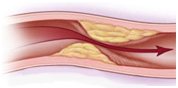 Carotid Endarterectomy Surgery India offers info on Cost Carotid Endarterectomy Surgery India, Carotid Endarterectomy India