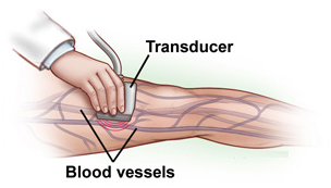 Diabetic Foot Ulcers India, Efficacy Of RHPDGF Based Gel In Diabetic Foot Ulcers India