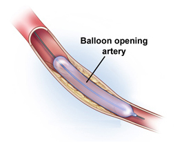 Stent India, Chest Pain India, Angina India, Interventional Radiology India, Peripheral Arterial Disease India, Renal Hypertension India