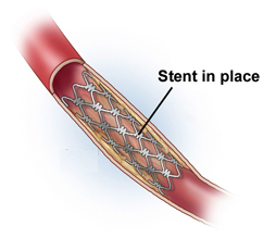 Arteriosclerosis India, Plaques India, Stent India, Chest Pain India, Angina India