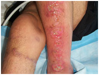 Lower Leg Ulcers Treatment India offers info on Cost Leg Ulceration - Ethnicity India, Leg Ulcers Associated With Sideroblastic Anemia India, Wound India