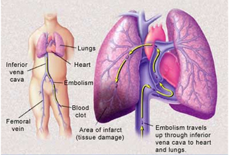 DVT India, Vascular Surgeon India, Catheter India, High Blood Pressure India, Lungs India, Angiography India