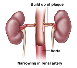 Radiological Diagnosis And Treatment offers info on Renovascular India, Kidney India, Artery Stenosis India