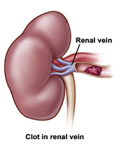 Artery Stenosis India, Vein Thrombosis India, Pulmonary Embolism India, Hardening Of The Arteries India, Nephrotic Syndrome India