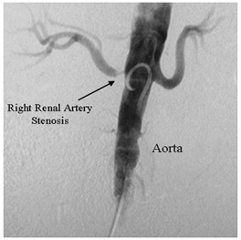 Radiological Diagnosis And Treatment offers info on Renovascular India, Kidney India, High Blood Pressure India, Blood Clot India, Hardening Of The Arteries India