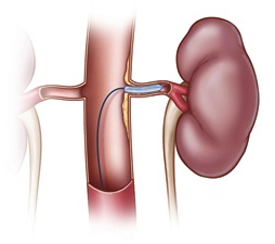 Radiological Diagnosis And Treatment offers info on Renovascular India, Kidney India