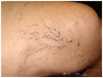 Spider Veins Treatment India, Spider Vein Treatment in India, Varicose Veins - Spider Veins Treatment India