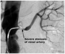 Radiological Diagnosis And Treatment offers info on Renovascular India, Kidney India, Artery Stenosis India, Pulmonary Embolism India, Blood Clot India