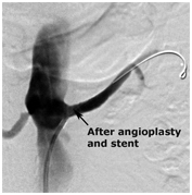 Plaques India, Stent India, Chest Pain India, Angina India, Interventional Radiology India, Renal Hypertension India