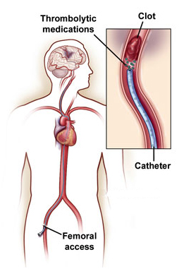 Thrombolytic Therapy India, Thrombolysis India, Echocardiogram India, Thrombolytic Therapy India, Thrombus India