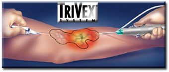 Trivex-Advanced Varicose Vein Treatment India offers info on Cost Trivex-Advanced Varicose Vein Treatment India