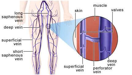 Varicose Vein Surgery India offers info on Cost Varicose Vein Surgery Hospital India, Varicose Vein Surgery India