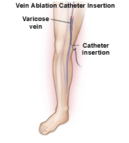 Vein Ablation Surgery India, India Vein Ablation Surgeon Hospital India offers info on Vein Ablation for Varicose Veins India