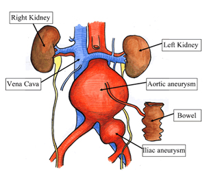 Abdominal Aortic Aneurysm India, Aortic Aneurysm Treatment India, Aortic Aneurysm India