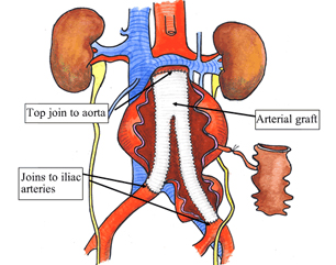 Abdominal Aortic Aneurysm India, Aortic Aneurysm Treatment India, Aortic Aneurysm India