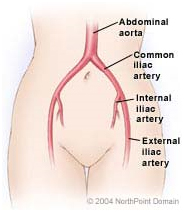 Aortoiliac Occlusive Disease Treatment offers info on Aortoiliac Occlusive Disease India, Vascular Disease India