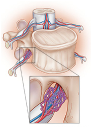 Arteriovenous Fistula Surgery offers info on Fistula Surgery India, Arteriovenous Fistula India