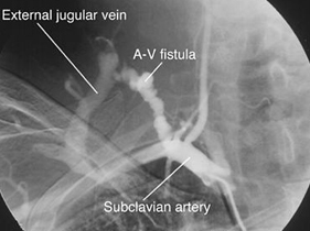 Arteriovenous Fistula India, Arteriovenous Fistulas Surgery India, Arteriovenous Fistulas Side Effects India