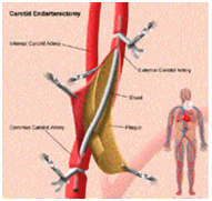 Carotid Artery India, Atherosclerosis India