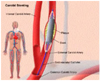 Atherosclerotic Disease Of The Carotid Artery Treatment India offers info on Atherosclerotic Disease Of The Carotid Artery India, Atherosclerosis India