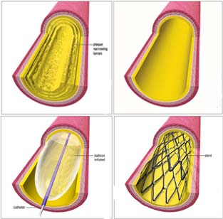 Balloon India, Angioplasty India, Balloon Angioplasty Surgery India, Arteries India